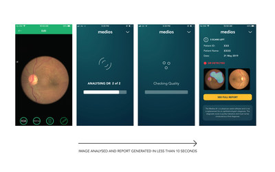 Automated Diabetic Retinopathy detection by The World